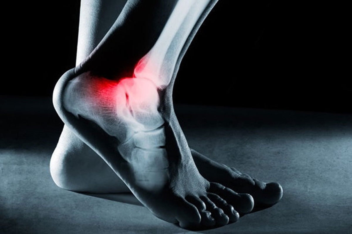 Sudden ankle pain without injury can be confusing and frustrating, especially when there’s no obvious cause like a fall or twist. For many people, this pain may come on gradually or appear overnight, disrupting daily movement and quality of life. Understanding what might be behind this discomfort is the first step to getting relief. In this blog, we'll explore the common causes of unexplained ankle pain, when to seek help, treatment options, and why working with a trusted foot and ankle specialist—like those at Wisconsin Foot & Ankle Clinic—can make all the difference. Whether you’re experiencing sudden ankle pain without injury or swelling, persistent stiffness, or intermittent pain, professional evaluation is key to recovery.
Common Causes of Ankle Pain Without Injury
Experiencing ankle pain without injury doesn’t always mean nothing is wrong. Subtle and chronic conditions can affect the joints, tendons, and nerves in the ankle, often going unnoticed until pain appears. These are the most frequent medical reasons behind sudden ankle pain without injury:
Arthritis and Autoimmune Conditions
Osteoarthritis and rheumatoid arthritis can cause chronic ankle pain through inflammation and joint deterioration. These conditions may also lead to stiffness, swelling, and reduced range of motion. Autoimmune conditions like lupus and reactive arthritis can flare up suddenly and cause intense joint pain even without any physical trauma. Morning stiffness and pain are common indicators. In advanced cases, disease-modifying antirheumatic drugs (DMARDs) may be required.
Tendonitis and Overuse Injuries
Repetitive movements, poor biomechanical issues, and increased activity levels can contribute to tendon inflammation. Conditions such as Achilles tendonitis, posterior tibial tendon dysfunction (PTTD), bursitis, and tibialis anterior tendonitis are all examples of overuse injuries that may lead to ankle pain without any obvious injury. These often present as swelling and pain after activity, pain with ankle movement, or localized pain. Treatment often involves rest and activity modification, physical therapy, and the use of orthotics or support devices.
Nerve Compression Syndromes
Tarsal tunnel syndrome is a common nerve compression issue in the ankle. It can cause burning or tingling pain, tingling or numbness, or pain radiating to other areas of the foot. This kind of discomfort may not be tied to a specific event but can significantly impair mobility. Diagnostic techniques like nerve studies and gait analysis are often essential to uncover the root cause.
Gout and Other Metabolic Disorders
Sudden, severe ankle pain can also result from gout—a buildup of uric acid crystals in the joint. This often causes swelling, redness or warmth, and tenderness. Pseudogout and other metabolic conditions can mimic similar symptoms and require blood tests, tissue culture, or imaging tests for proper diagnosis. These conditions can sometimes feel like a broken bone or soft tissue injury due to the sharp intensity of pain.
Structural Issues: Flat Feet and High Arches
People with flat feet or high arches are more likely to develop ankle pain due to improper weight distribution and biomechanical stress. These structural conditions can lead to persistent strain on tendons and ligaments, causing pain even in the absence of injury. The use of orthotic shoes or inserts and proper arch support can offer significant relief and prevent further issues like osteochondral lesion of the talus (OLT) or stress fracture.
When to Seek Medical Attention
Knowing when ankle pain warrants professional evaluation is critical to avoid worsening the issue or missing a more serious diagnosis. This is especially important if you're dealing with sudden ankle pain without injury or swelling that doesn’t respond to home care.
Recognizing Red Flags
You should seek immediate care if you notice redness or warmth in the ankle, tingling or numbness, pain with ankle movement, or worsening pain. Persistent pain, difficulty bearing weight, ankle instability, or swelling that doesn’t improve with rest are key warning signs. These symptoms may indicate signs of infection, inflammation, or even ankle fractures.
Diagnostic Approaches
A podiatrist or orthopedic doctor will typically begin with a full medical history review and physical examination. Advanced diagnostics like X-rays, CT scans, or MRI help detect soft tissue damage, ankle injury types, or degenerative joint disease. A gait analysis, range of motion test, and nerve studies may be conducted to identify biomechanical issues and neurological contributors to pain.
Treatment Options for Non-Injury Ankle Pain
Fortunately, there are several effective ways to treat ankle pain without injury. Whether the pain stems from inflammation, nerve irritation, or biomechanical misalignment, targeting the root cause is essential for long-term relief. A personalized treatment plan developed by a podiatrist can help prevent recurring flare-ups and restore functional movement.
Home Remedies and Lifestyle Modifications
Initial treatment often includes RICE (rest, ice, compression, elevation), ice or heat therapy, pain relief medicine, and supportive footwear. Other helpful strategies include stretching, yoga, warm-up routines, and improving ankle strength and flexibility. Balance training, cushioning, and avoiding overuse can reduce daily stress on your joints.
Medical Interventions
When home remedies aren’t enough, your provider may recommend advanced care. Common treatments include nonsteroidal anti-inflammatory drugs (NSAIDs), corticosteroids, injections, topical creams or rubs, or even surgical intervention in severe cases. Customized ankle braces or splints and orthotic shoes or inserts can also help stabilize and correct alignment.
Preventative Measures
Preventing non-injury ankle pain involves strengthening surrounding muscles, improving mobility, and correcting alignment issues. Routine stretching and strengthening exercises, resistance training, and using proper footwear are crucial. A consistent routine guided by physical therapy can reduce risk and prevent recurrence.
Understanding Ankle Injury Types
Even when it feels like no injury occurred, subtle trauma or strain may still be to blame. Small or unnoticed injuries—like microtears or stress fractures—can manifest later as unexplained pain. Early detection through proper evaluation ensures these underlying issues don’t develop into chronic problems.
Overview of Common Ankle Injuries
Ankle injuries are extremely common, especially among active individuals and athletes. Acute ankle sprains, for example, occur frequently across all levels of sports, accounting for roughly 15% of injuries sustained in both high school and collegiate athletics. These injuries often happen during quick directional changes or uneven landings and can cause immediate pain and swelling.
Common ankle injury types include ankle sprains, ankle fractures, tendon strains, and cartilage damage. These injuries may happen during regular activities and can be misinterpreted as non-injury pain. Ankle sprain treatment typically includes RICE, therapy, and in some cases, surgical repair. Ignoring these injuries can delay recovery and lead to chronic issues.
Differentiating Injury from Non-Injury Pain
Ankle sprains are not only common but also notorious for becoming chronic. Research shows that up to 40% of individuals who suffer from an ankle sprain may develop long-term symptoms—including ongoing pain, swelling, and instability—that persist for at least a year after the initial injury. Recognizing the difference between a healing sprain and lingering dysfunction is crucial to avoid repeat injuries and ensure full recovery.
True injury-related pain usually follows a specific event, such as twisting your ankle during a workout. Non-injury pain, however, may develop slowly or appear suddenly without an incident. A thorough evaluation is necessary to distinguish between the two and to ensure appropriate treatment from a qualified podiatrist or foot specialist.
Why Choose Wisconsin Foot & Ankle Clinic for Ankle Pain Care
When unexplained ankle pain impacts your daily life, you need experts who specialize in diagnosing and managing complex foot and ankle conditions.
Specialists in Hard-to-Diagnose Ankle Conditions
At Wisconsin Foot & Ankle Clinic, we excel at uncovering the underlying causes of sudden ankle pain without injury—especially when there’s no clear trauma. We have experience treating a wide range of conditions from autoimmune joint disorders to overuse injuries and nerve entrapment.
Advanced Diagnostic Tools, Personalized Treatment
We use advanced imaging, biomechanical assessments, and gait analysis to identify the root cause of your symptoms. Every treatment plan is customized to help restore mobility and reduce persistent pain. From supportive devices to surgical solutions, we provide end-to-end care.
Local, Trusted Foot and Ankle Experts
As your reliable "foot and ankle doctor near me," our clinic proudly serves the community with same-week availability, compassionate care, and long-term solutions. Whether it’s managing chronic pain or providing immediate relief for a flare-up, we’re here to help.
Conclusion
Sudden ankle pain without injury doesn’t mean there isn’t a serious issue beneath the surface. From rheumatoid arthritis and bursitis to nerve compression or stress fractures, accurate diagnosis is key. Don’t let persistent pain limit your movement—schedule a visit with Wisconsin Foot & Ankle Clinic and get expert care you can trust.
FAQs
Why has my ankle suddenly started hurting?
Your ankle may suddenly hurt due to inflammation, arthritis, tendon overuse, or a metabolic issue like gout. These causes can create pain even without an injury.
What is the fastest way to relieve ankle pain?
Use RICE, ice or heat therapy, NSAIDs, and supportive footwear. If the pain doesn’t subside, consult a podiatrist for personalized care.
Can ankle arthritis come on suddenly?
Yes. Ankle arthritis—particularly in autoimmune or metabolic conditions—can cause sudden flare-ups, even when there’s no prior history of injury. Professional evaluation ensures proper treatment.
