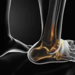 3D medical illustration of an ankle dislocation highlighting joint misalignment and bone structure in the foot and lower leg.