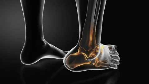 3D medical illustration of an ankle dislocation highlighting joint misalignment and bone structure in the foot and lower leg.