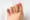 Swollen and bruised foot with visible discoloration on the fifth toe, showing signs of a broken pinky toe injury.