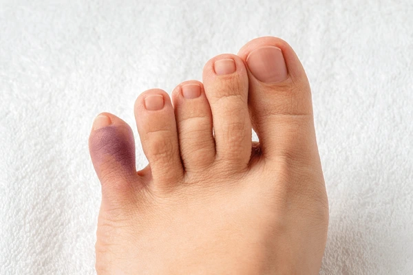 Swollen and bruised foot with visible discoloration on the fifth toe, showing signs of a broken pinky toe injury.