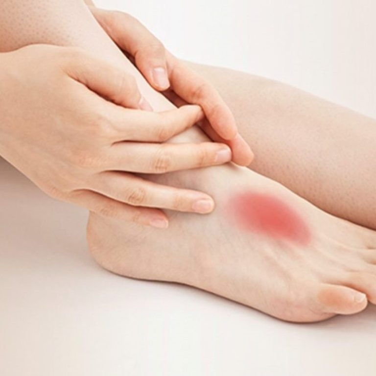 Arthritis in Top of Foot – Causes, Diagnosis & Treatment