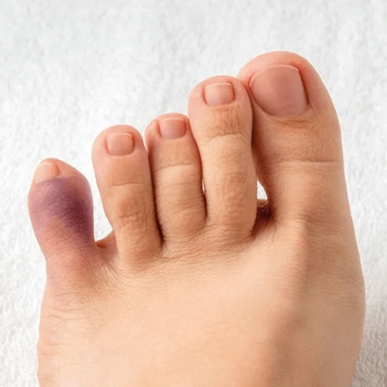 Swollen and bruised foot with visible discoloration on the fifth toe, showing signs of a broken pinky toe injury.